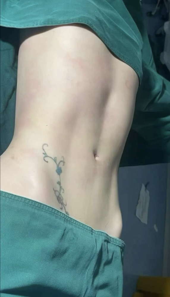 腹部脂肪吸引の施術後