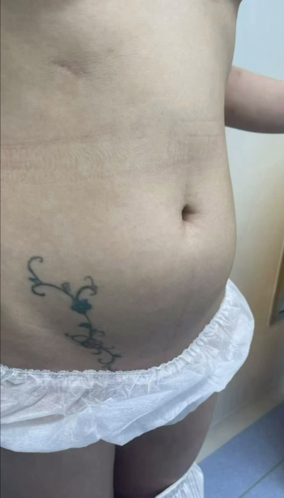腹部脂肪吸引の施術前